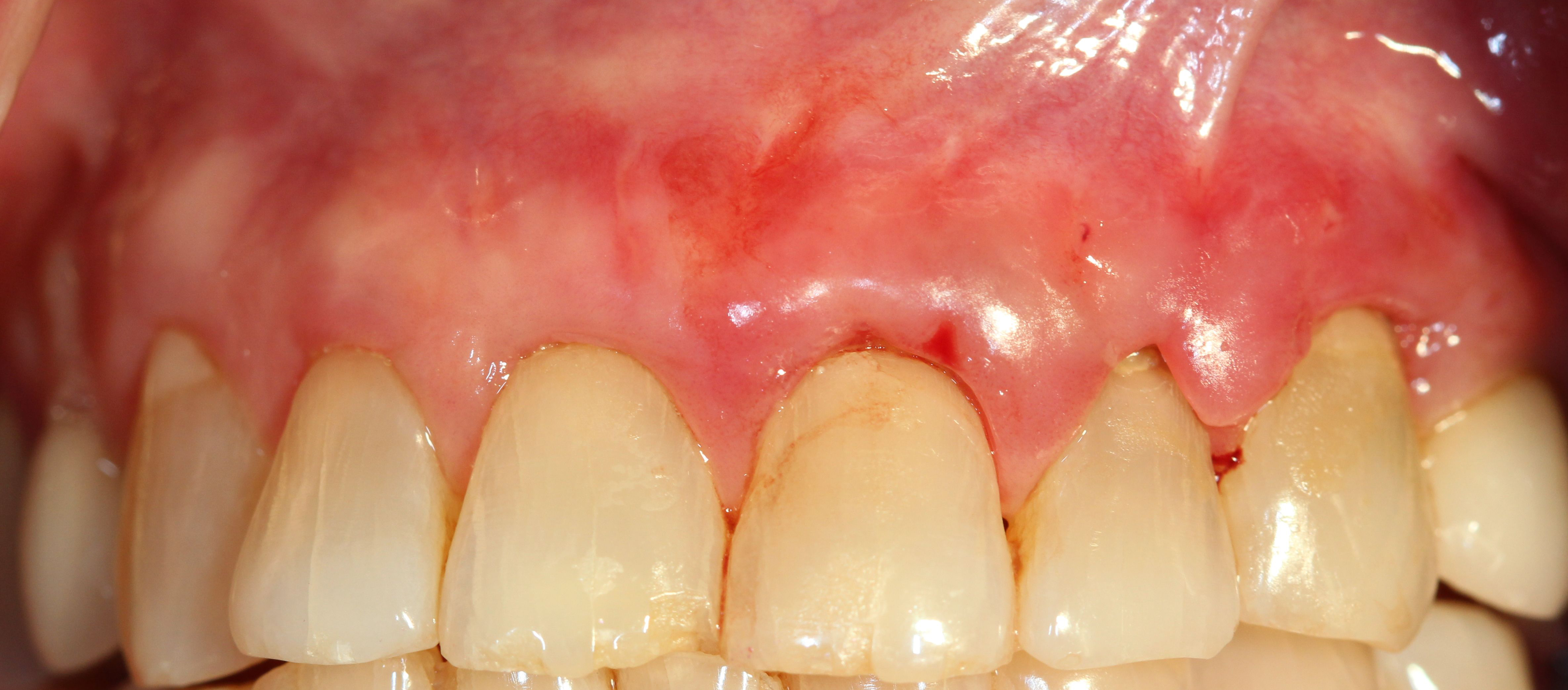 Upper anterior teeth after surgery